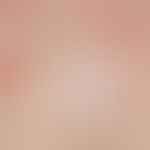 Erythema infectiosum: generalized exanthema with larger and smaller, in its complete manifestatio...