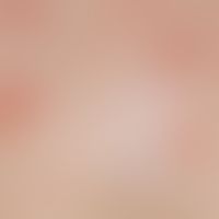 Erythema infectiosum: generalisiertes Exanthem mit größeren und kleineren, in kompletter Ausprägu...
