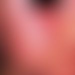 Erythema infectiosum: Intense, extensive, butterfly-shaped redness and swelling of the cheeks, ac...