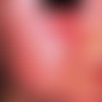 Erythema infectiosum. Intensive, flächenhafte, schmetterlingsförmige Rötung und Schwellung der Wa...