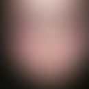Erythema infectiosum. Nach leichtem "grippalem" Infekt intensive Rötung (und Schwellung) beider W...