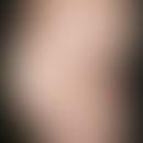 Erythema migrans arciforme et palpabile. Multiple, chronisch stationäre, am Rumpf lokalisierte, d...