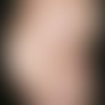 Erythema migrans arciforme et palpabile. multiple, chronically stationary, disseminated, blurred,...