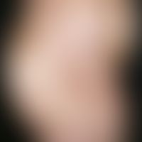 Erythema migrans arciforme et palpabile. Multiple, chronisch stationäre, am Rumpf lokalisierte, d...