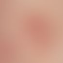 Erythema necroticans migrans. Grob lamellär schuppende Erytheme mit randständigen Pusteln bei Glu...