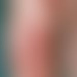Erythema nodosum. Multiple, unscharf begrenzte, sehr druckschmerzhafte, teigige, leicht erhabene,...