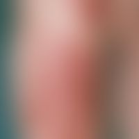 erythema nodosum. multiple, blurred, very pressure painful, doughy, slightly raised, reddish-livi...