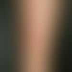 Erythema nodosum. Seit mehreren Tagen bestehende, hochschmerzhafte, unscharf begrenzte, rote Plaq...