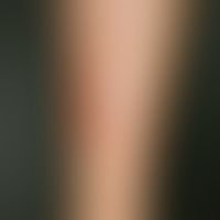 Erythema nodosum. red plaques and deep nodular formation, which have been present for several day...