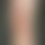 Erythema nodosum. Multiple, stellenweise konfluierte, schmerzhafte indurierte Plaques und Knoten....