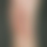 erythema nodosum. multiple, in places confluent, painful indurated plaques and nodules. occurs ab...