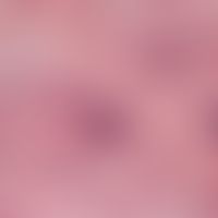 Erythema nodosum. full-stage erythema nodosum. granulomatous septal panniculitis with lympho-hist...