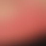 Erythema palmare et plantare symptomaticum. Detailausschnitt: Bei dem 47-jährigen Patienten fiel ...