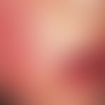 Erythema perstans faciei. Persistierendes, schmetterlingsförmiges, lividrotes Erythem bei einem 3...