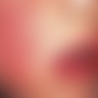 Erythema perstans faciei. Persistierendes, schmetterlingsförmiges, lividrotes Erythem bei einem 3...