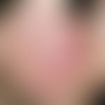 Erythema perstans faciei. Persistierende, symptomarme, symmetrisch angeordnete Gesichtsrötung, di...