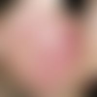Erythema perstans faciei. Persistierende, symptomarme, symmetrisch angeordnete Gesichtsrötung, di...