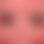 Erythrodermie: universelle Rötung des Gesichtes sowie Schuppung im Gesicht eines 77-jährigen Pat....