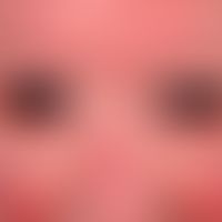 Erythrodermie: universelle Rötung des Gesichtes sowie Schuppung im Gesicht eines 77-jährigen Pat....
