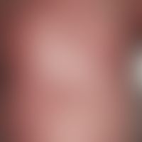 Erythrodermia. universal, chronically stationary, for 3 months constant reddening of the skin wit...
