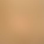Erythrokeratodermia progressiva symmetrica. close-up: Dirty-brown hyperkeratosis in the area of t...