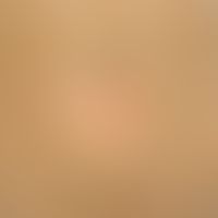 Erythrokeratodermia progressiva symmetrica. close-up: Dirty-brown hyperkeratosis in the area of t...