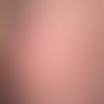 Erythrokeratodermia figurata variabilis. Detailausschnitt mit polyzyklischen, stellenweise urtika...