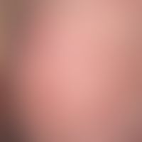 Erythrokeratodermia figurata variabilis. Detailausschnitt mit polyzyklischen, stellenweise urtika...
