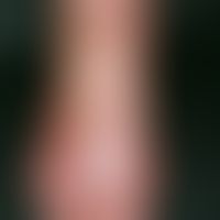 Erythromelalgie. Anfallsweise auftretende, schmerzhafte, hyperämische, gerötete und geschwollene ...