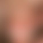 Erythroplasia. initial erythroplasia without subjective symptoms. sharply limited erosion with sm...