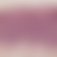 Erythroplasia. pronounced acanthosis, parakeratotic keratinization, the histoarchitecture of the ...