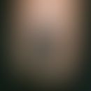 Melanom malignes subunguales: Nagel mit streifiger und periungualer, brauner Zeichnung (Hutchinso...