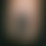 Melanom malignes subunguales: Nagel mit streifiger und periungualer, brauner Zeichnung (Hutchinso...