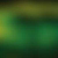 Melanom, malignes, superfiziell spreitendes. 20 MHz-Sonographie: Echofreie Zone unterhalb des bre...