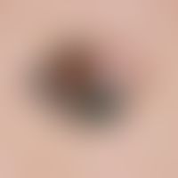 Melanoma, malignant, superficially spreading, irregularly limited and black-brown discolored pigm...