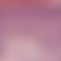 Melanom, malignes, superfiziell spreitendes. Randbereich des Tumors: Pagetoide Durchsetzung der u...