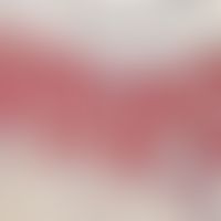 Melanom, malignes, superfiziell spreitendes. Immunhistologie (MART): Diffuse Durchsetzung von Obe...