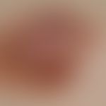 Melanom, malignes, superfiziell spreitendes. Regressives SSM: Unregelmäßig begrenzte, hellbraun b...