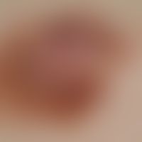 Melanom, malignes, superfiziell spreitendes. Regressives SSM: Unregelmäßig begrenzte, hellbraun b...
