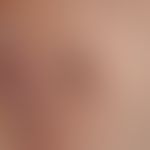 Melanom, malignes, superfiziell spreitendes. Paralabial links lokalisierte, ca. 2 x 2,5 cm durchm...