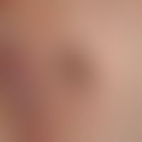 Melanom, malignes, superfiziell spreitendes. Paralabial links lokalisierte, ca. 2 x 2,5 cm durchm...