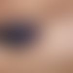 Melanom, malignes, superfiziell spreitendes. 2,0 x 1,4 cm große, braun-schwarze bis schwarze Plaq...