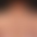 Melanoma, malignant, superficially spreading: Exceptionally large, 8.0x4.0 cm in diameter, regres...