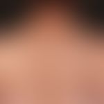 Melanom, malignes, superfiziell spreitendes: Außergewöhnliche großes, 8,0x4,0 cm durchmessendes, ...
