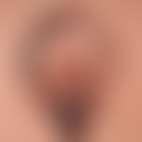 Melanoma malignes superficially spreading: detailed view
