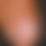 Melanonychia striata longitudinalis. initial findings in 2006. Completely asymptomatic longitudin...