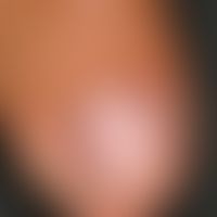 Melanonychia striata longitudinalis. initial findings in 2006. Completely asymptomatic longitudin...