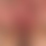 Lentigo of the mucosa: for 10 years persistent, irregular, blurred, band-shaped, almost circumfer...