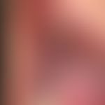 Lentigo of the mucosa. general view: Extensive mucosal melanosis of the oral cavity, especially o...