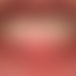 Lentigo of the mucosa: sharply defined, brownish hyperpigmentation in the sense of gingivamelanos...